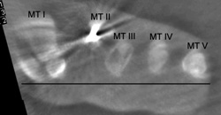 Die axiale Reformation der intraoperativen 3D-Röntgenbildgebung mit deutlich tiefer stehendem Metatarsale-3-Köpfchen.