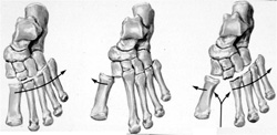 Lisfrancluxationsklassifikation nach Quenu und Küss:homolateral, isoliert, divergierend (von links nach rechts).