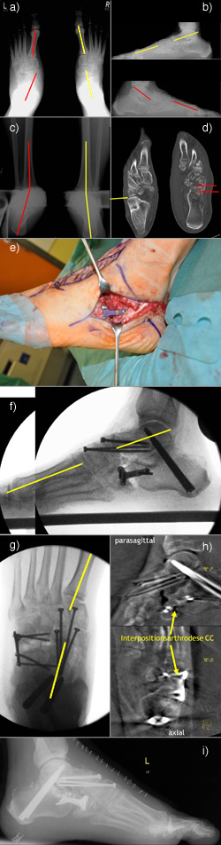 Übersehene Chopart-Luxations-Fraktur mit konsekutivem Pes abductoplanovalgus und schwerer posttraumatischer Arthrose im Chopart- und Subtalargelenk.