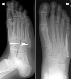 Metatarsale-5-Avulsionsfraktur und Versorgung mit einer sog. Kriechschraube