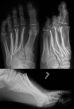 Dislozierte Köpfchenfrakturen der Metatarsale 2-4 im Rahmen eines Verkehrsunfalls, die nach beschriebener Technik mit antegrader Spickdrahtosteosynthese operativ versorgt wurden (a: präoperative Röntgenaufnahmen; b: postoperative Röntgenaufnahmen).