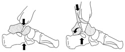 Pathomechanik der Talusluxationsfraktur (links) und der Taluscorpusluxationsfraktur (rechts).