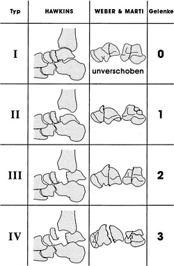 Klassifikation der Talushals- und -korpusfrakturen unter Berücksichtigung der betroffenen Gelenkebenen.