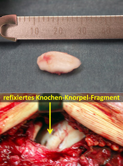 Ausprengung eines Knochen-Knorpelfragments von der lateralen Talusschulter (sog. Frlake fracture, Abbildung oben) und Refixation mit Spezielschrauben ohne Kopf (Abbildung unten).