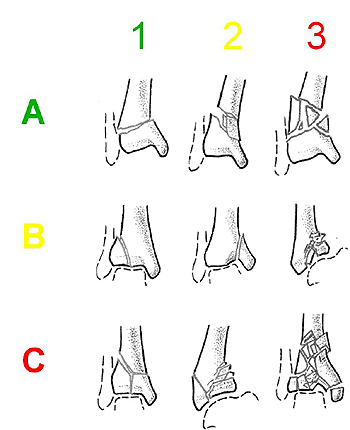 Klassifikation der Pilonfrakturen nach AO (Arbeitsgemeinschaft für Osteosynthesefragen)