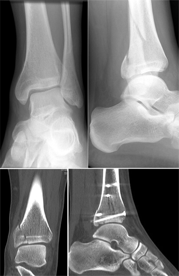 "Niedrigenergie-Pilon". Offene Reposition in Fixation mit Platten und Schrauben.