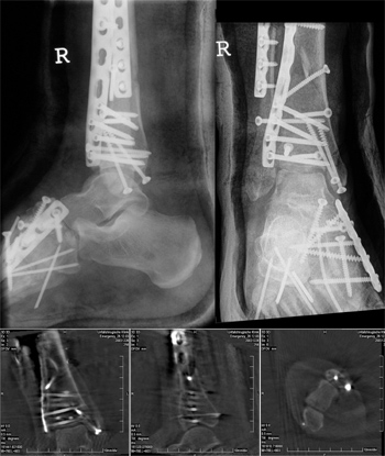 "Hochenergie-Pilon" als Teil einer komplexen Verletzung. Zweizeitige offene Reposition in Fixation mit Platten und Schrauben.