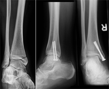 Isolierte Innenknöchelfraktur mit Schrauben-osteosynthetischer Versorgung.