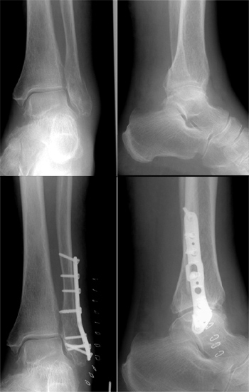 OSG-Luxationsfraktur bei stark osteoporotischem Knochen und Plattenosteosynthese mit winkelstabiler Platte.
