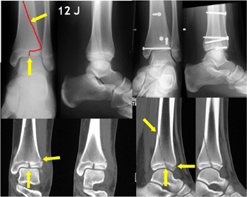 Übergangsfraktur ("Triplane") bei einem 12-jährigen Jungen mit osteosynthetischer Versorgung.