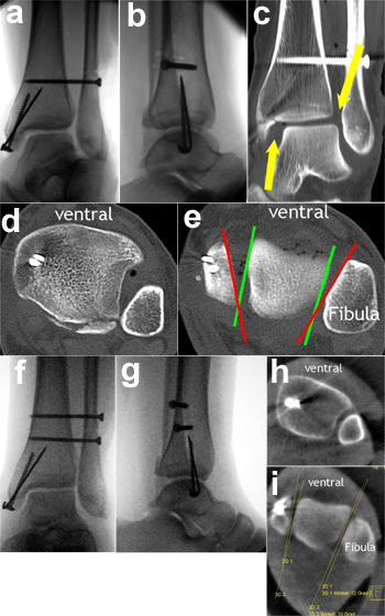 OSG-Luxationsfraktur Typ Weber-C, zunächst ohne intraoperative 3D-Röntgen-bildgebung