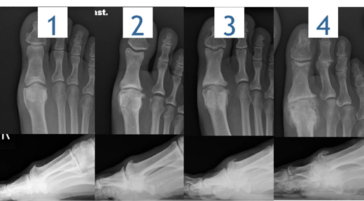 Stadieneinteilung Hallux rigidus