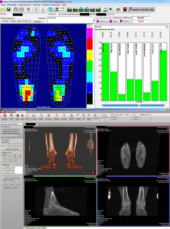 Bildschirmdarstellung einer Pedographie (oben) und gleichzeitigem PedCAT®-Scan.