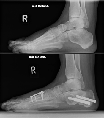 Schwerer Hohlfuss (oberes Bild). Korrektur eines Hohlfußes mit Korrekturosteotomien des Calcaneus und des Metatarsale 1 (unteres Bild). 