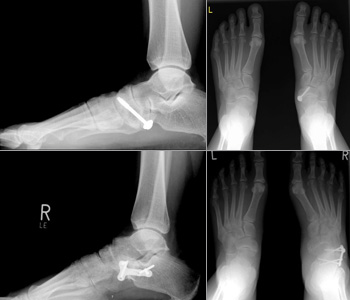 Gelenkerhaltende Korrektur eines Pes abductoplanovalgus mit Verlängerung des Kalkaneus, Verlagerung der Tibialis posterior Sehne und Verstärkung mit der Flexor digitorum longus Sehne.