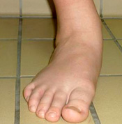 Abduktions-Pronationstellung des Fußes bei Pes abductoplanovalgus