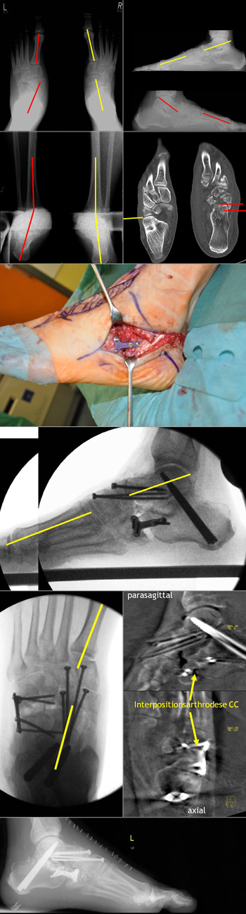 Übersehen Chopart-Luxations-Fraktur mit konsekutivem Pes abductoplanovalgus Korrektur Plattfuß (Pes abductoplanovalgus) beim Erwachsenen und schwerer posttraumatischer Arthrose im Chopart- und Subtalargelenk.