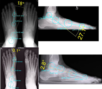 Plattfuß, gelenkerhaltend bei einem 47 jährigen Mann mit einem Tarso-Matatarsale-1(TMT)-Index von -45,1 Grad