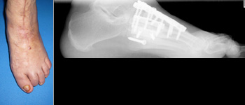 Komplexe navigierte Korrekturarthrodese bei fixiertem Pes abductoplanovalgus mit herkömmlichen Implantaten (Platten und Schrauben).