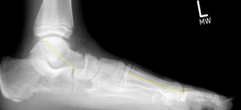Seitliche Röntgenaufnahme mit Belastung und Ausmessung der des seitlichen Talo-Metatarsale-1-Winkels (TMT seitlich).