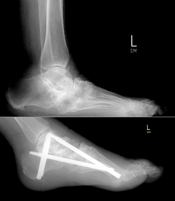 Komplexe navigierte Korrektur bei fixiertem Pes abductoplanovalgus und Fixierung mit Midfoot Fusion Bolts®