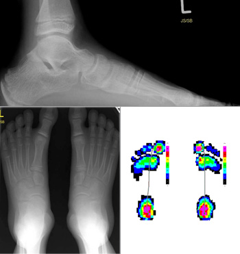 Pes abductoplanovalgus Grad 1 mit TMT-Index 0°bis -20°.