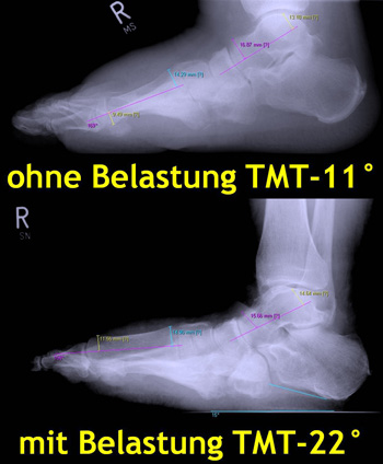 Vergleich Röntgen mit und ohne Belastung mit deutlich unterschiedlichem Talo-Metatarsale-1-Winkel (TMT).