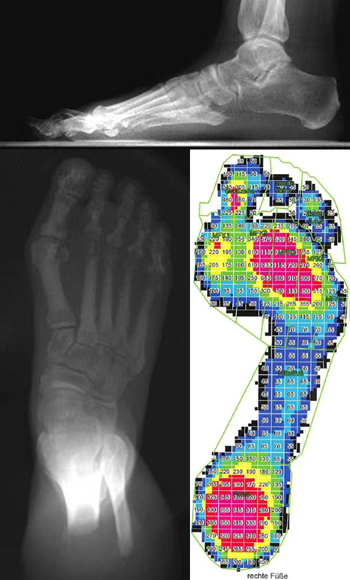 Pes abductoplanovalgus Grad 2 mit TMT-Index -21°bis -40°.