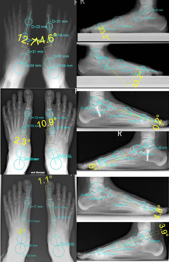 Plattfuß bei einem 10 jährigen Mädchen mit einem Tarso-Matatarsale-1(TMT)-Index von -37,8/-35,9 Grad rechts/links