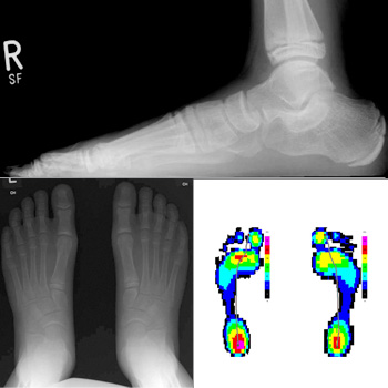 Pes abductoplanovalgus Grad 2 mit TMT-Index -21°bis -40°