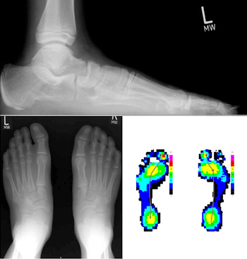 Pes abductoplanovalgus Grad 3 mit TMT-Index -41°bis -60°