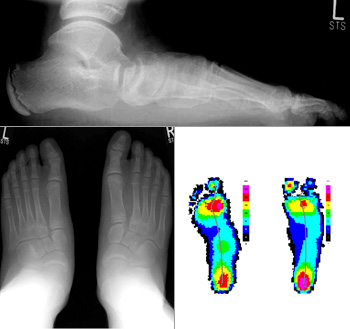 Pes abductoplanovalgus Grad 4 mit TMT-Index <-60° links