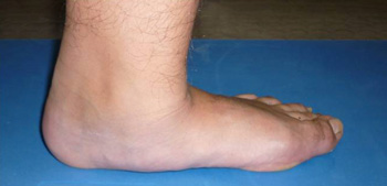 Verkleinerung / Fehlen der belastungsfreien Zone in der Mitte der medialen Fußsäule bei Pes abductoplanovalgus