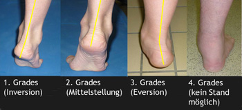 4 Schweregrade der Tibialis-posterior-Insuffizienz bei Pes abductoplanovalgus