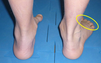 "Too many toe sign" bei Pes abductoplanovalgus