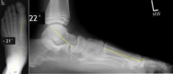 Berechnung des Talo-Metatarsale-1-Index (TMT-Index) durch Addition des TMT dorsoplantar und des TMT seitlich.  Beim Pes abductoplanovalgus sind die Werte negativ, hier besteht ein TMT-Index von -43°.