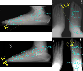 Plattfuß bei einem 13 jährigen Jungen mit einem Tarso-Matatarsale-1(TMT)-Index von -42,9 Grad