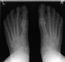 In deutlicher Deformität verheilte auswärtige minimalinvasive Korrektur eines Hallux valgus