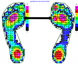Die Abbildung zeigt das Maximaldruckbild der präoperativen dynamischen Standardpedographie mit deutlicher Verringerung des Kraftanteils plantar des Metatarsale-1-Köpfchens (links) im Vergleich zur Gegenseite (rechts).