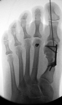 Intraoperatives Röntgenbildverstärkerbilder dorsoplantar.