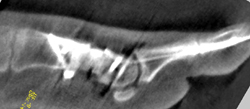 Intraoperatives 3D-Bild sagittal.