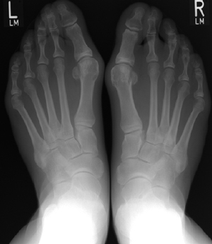 Vorfußdeformität mit Hallux valgus beidseits