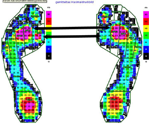Maximaldruckbild der präoperativen dynamischen Standardpedographie
