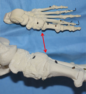 Korrekturarthrodese Tarso-Metatarsal-1-Gelenk (modifizierter Lapidus, roter Pfeil) am Knochenmodell mit Schraubenfixierung.