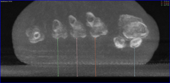 Messung der Höhe der Metatarsaleköpfchen im 3D-Datensatz der 3D-gRöntgenbildgebund mit PedCAT