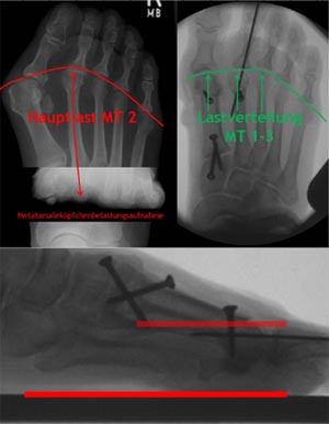 Vorfußkorrektur mit Verkürzungsosteotomie des Metatarsale 2 bei Metatarsalgie