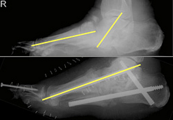Komplexe navigierte Plattfußkorrektur bei Charcotfuß und Fixierung mit Midfoot Fusion Bolts®