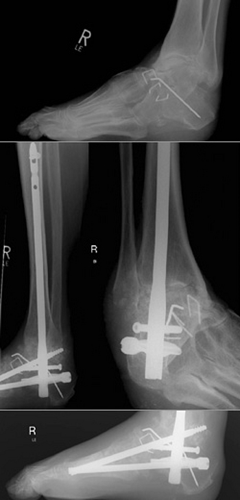 Komplexe navigierte Plattfußkorrektur bei Charcotfuß und Fixierung mit Midfoot Fusion Bolts® und retrogradem Arthrodesenagel.