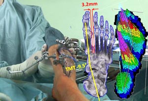 Holographische virtuelle Darstellung der Knochenposition und Kraftverteilung über dem Operationssitus bei einer Korrekturarthrodese des Mittelfußes/Lisfrancgelenks.