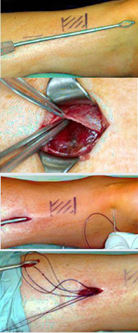 Perkutane Achillessehnennaht mit Spezialinstrumentarium (Dresdner Instrument)